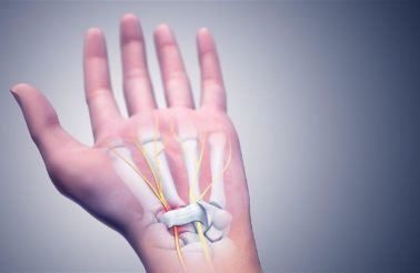 Carpal Tunnel due to Welding